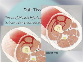 Types of Muscle InjuriesTypes of Muscle Injuries
2.2.ContusionsContusions (Clinical features)(Clinical features)
• Intermuscular heamatoma
– Damage includes facia and adjacent blood vessels
– Bleeding occurring between muscles
– No pressure building up as in intramuscular type
– Bruising and swelling appear distally to damage area within
24- 48 hrs.
– Muscle function returns
– Prognosis is better than intramuscular type
Soft Tissue InjuriesSoft Tissue Injuries
 