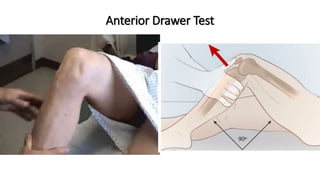 Anterior Drawer Test
 