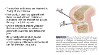 • The trochar and sleeve are inserted at
70deg of knee flexion
• Firm gradual pressure applied until
there is a reduction in resistance,
indicating that the trochar has passed
through the joint capsule
• Knee is extended around 20deg of
flexion and the trochar advanced
passing through the patellofemoral
joint
• Its intraarticular position can be
confirmed by sweeping the
arthroscope gently from side to side it
can felt beneath the patella
 