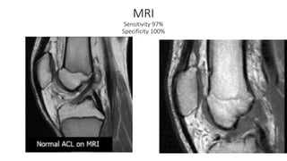 MRI
Sensitivity 97%
Specificity 100%
 