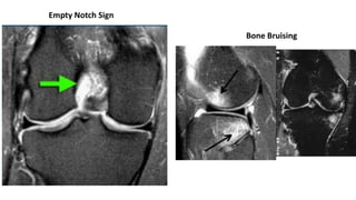 Empty Notch Sign
Bone Bruising
 