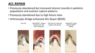 ACL REPAIR
• Previously abandoned but increased interest recently in pediatric
populations and avulsion rupture patterns
• Previously abandoned due to high failure rates
• Arthroscopic Bridge-enhanced ACL Repair (BEAR)
 