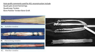 Auto-grafts commonly used for ACL reconstruction include
Quadruple strand Hamstrings
Quadriceps Tendon
Bone Patellar Tendon Bone Graft
 