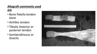 Allograft commonly used
are
• Bone Patella tendon
bone
• Achilles tendon
• Tibialis Anterior or
posterior tendon
• Semitendinosus or
Gracilis
 