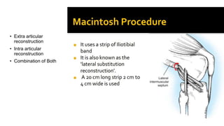 • Extra articular
reconstruction
• Intra articular
reconstruction
• Combination of Both
 