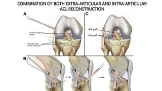 COMBINATION OF BOTH EXTRA-ARTICULAR AND INTRA-ARTICULAR
ACL RECONSTRUCTION
 