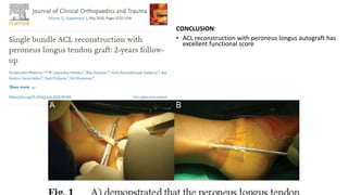 CONCLUSION:
• ACL reconstruction with peroneus longus autograft has
excellent functional score
 