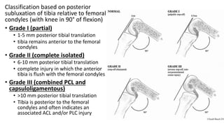 Classification based on posterior
subluxation of tibia relative to femoral
condyles (with knee in 90° of flexion)
• Grade I (partial)
• 1-5 mm posterior tibial translation
• tibia remains anterior to the femoral
condyles
• Grade II (complete isolated)
• 6-10 mm posterior tibial translation
• complete injury in which the anterior
tibia is flush with the femoral condyles
• Grade III (combined PCL and
capsuloligamentous)
• >10 mm posterior tibial translation
• Tibia is posterior to the femoral
condyles and often indicates an
associated ACL and/or PLC injury
 