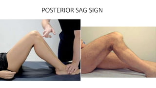 POSTERIOR SAG SIGN
 