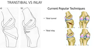 TRANSTIBIAL VS INLAY
 