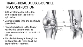 TRANS-TIBIAL DOUBLE-BUNDLE
RECONSTRUCTION
• Split achilles tendon is fixed to
isometric point of the femoral
epicondyle
• One tibia-based limb and one fibula-
based limb
• Fibula-limb is fixed to the fibular
head with a bone tunnel and
transosseous sutures to reconstruct
the LCL
• Tibia-limb is brought through the
posterior tibia to reconstruct the
popliteofibular ligament
 