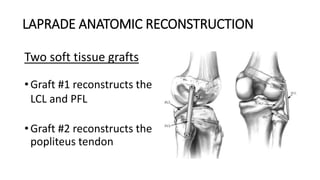 LAPRADE ANATOMIC RECONSTRUCTION
Two soft tissue grafts
• Graft #1 reconstructs the
LCL and PFL
• Graft #2 reconstructs the
popliteus tendon
 