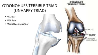 O’DONOHUES TERRIBLE TRIAD
(UNHAPPY TRIAD)
• ACL Tear
• MCL Tear
• Medial Meniscus Tear
 