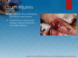 Crush Injuries
 An injury to the underlying
soft tissues and bones
 Caused by a body part
being crushed between
two solid objects
© Mark C. Ide
 