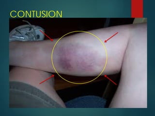 CONTUSION
 