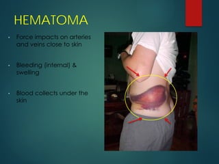 HEMATOMA
 