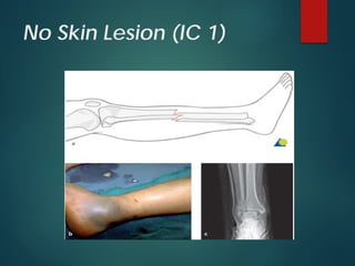 No Skin Lesion (IC 1)
 
