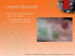 Closed Wounds
 Soft tissue is damaged but
skin is not broken
 Characteristic closed
wound is a contusion.
 