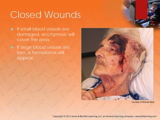 Closed Wounds
 If small blood vessels are
damaged, ecchymosis will
cover the area.
 If large blood vessels are
torn, a hematoma will
appear.
Courtesy of Rhonda Beck
 