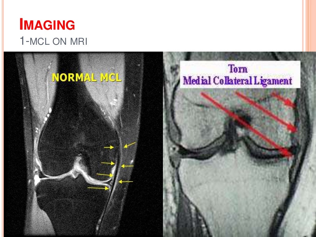 Soft tissue injury of the knee