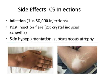 Injection Atrophy Soft tissue & intra-articular local injection.ppt