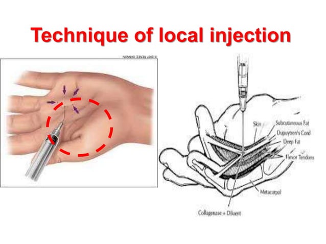 Local Infiltration Injection Soft tissue & intra-articular local injection.ppt