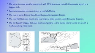• The retraction cord must be moistened with 25 % aluminum chloride (hemostatic agent) in a
dappen dish.
• Removing dry cord cancause injury to epithelial lining.
• The cord is formed into aU andlooped around the prepared tooth.
• The cord held between thumb andfore finger, a slight tension applied in apicaldirection.
• The cord gently slipped between tooth and gingiva in the mesial interproximal area with a
Fischer packinginstrument.
 