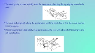 • The cord gently pressed apically with the instrument, directing the tip slightly towards the
root.
• The cord slid gingivally along the preparation until the finish line is felt, then cord pushed
into the crevice.
• If the instrument directed totally in apical direction, the cord will rebound off the gingiva and
roll out of sulcus.
 