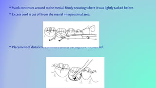 • Work continues around to the mesial, firmly securing where it was lightly tacked before.
• Excesscord is cut off from the mesial interproximal area.
• Placement of distal end continued until it overlaps the mesial end .
 