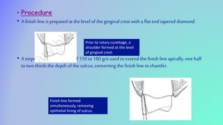 • Procedure
• A finish line is prepared at the level of the gingival crest with a flatend tapered diamond.
• A torpedo nosed diamond of 150 to 180 grit used to extend the finish line apically,one half
to two thirds the depth of the sulcus,converting the finish line to chamfer.
Prior to rotary curettage, a
shoulder formed at the level
of gingival crest.
Finish line formed
simultaneously, removing
epithelial lining of sulcus.
 