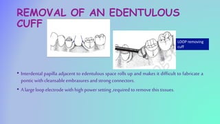 REMOVAL OF AN EDENTULOUS
CUFF
• Interdental papilla adjacent to edentulous space rolls up and makes it difficult to fabricate a
pontic with cleansableembrasures and strong connectors.
• A large loop electrode with high power setting ,required to remove thistissues.
LOOP removing
cuff
 