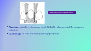• Advantage: minimal recession ranging from 0.1 in healthy adolescence to 0.3 mm in general
population.
• Disadvantage: can causeincisionalinjuries of gingival tissues.
Copper band displacing free gingiva
 