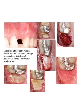 Soft tissue management around dental implant | PPTX