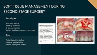 Comprehensive Soft Tissue Management in Dental Implants for Optimal ...