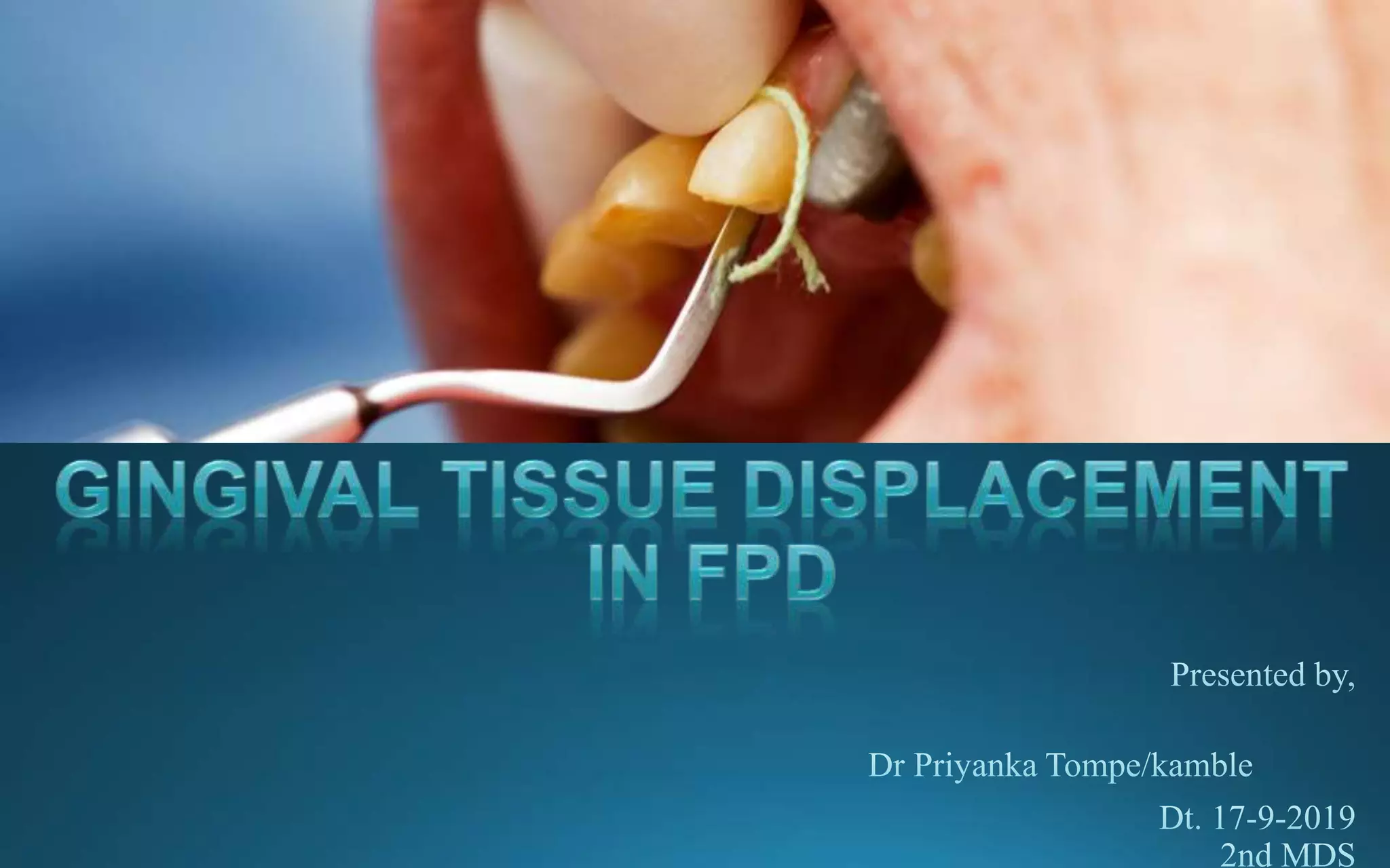 Gingival Tssue Displacement In FPD PPT