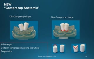 Gingival Tssue Displacement In FPD | PPTX
