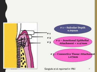 08/20/2024 10
# 1
# 2
# 3
# 1 – Sulcular Depth
0.69mm
# 2 – Junctional Epithelial
Attachment = 0.97mm
# 3 – Connective Tissue Attachment
1.07mm
Gargiulo et al. reported in 1961
 