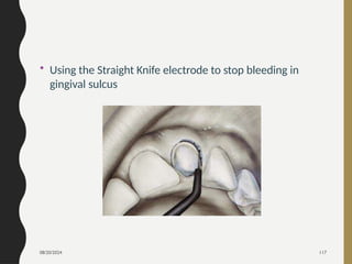 08/20/2024 117
• Using the Straight Knife electrode to stop bleeding in
gingival sulcus
 
