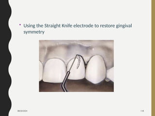 08/20/2024 118
• Using the Straight Knife electrode to restore gingival
symmetry
 