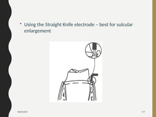 08/20/2024 119
• Using the Straight Knife electrode – best for sulcular
enlargement
 