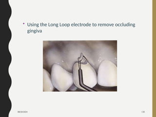 08/20/2024 120
• Using the Long Loop electrode to remove occluding
gingiva
 