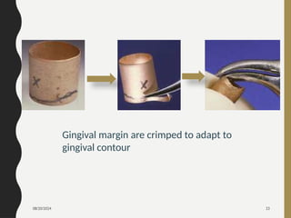 08/20/2024 23
Gingival margin are crimped to adapt to
gingival contour
 
