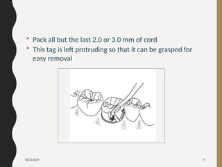 08/20/2024 71
• Pack all but the last 2.0 or 3.0 mm of cord
• This tag is left protruding so that it can be grasped for
easy removal
 