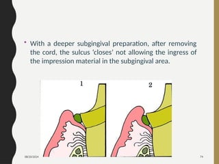 08/20/2024 74
• With a deeper subgingival preparation, after removing
the cord, the sulcus ‘closes’ not allowing the ingress of
the impression material in the subgingival area.
 