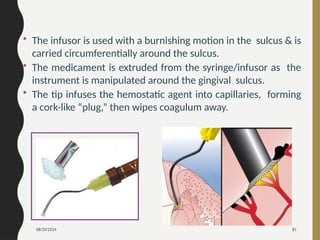 08/20/2024 81
• The infusor is used with a burnishing motion in the sulcus & is
carried circumferentially around the sulcus.
• The medicament is extruded from the syringe/infusor as the
instrument is manipulated around the gingival sulcus.
• The tip infuses the hemostatic agent into capillaries, forming
a cork-like “plug,” then wipes coagulum away.
 