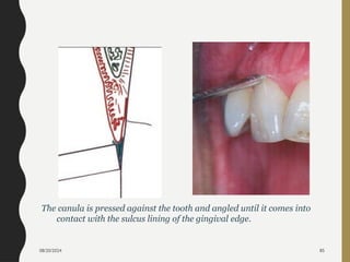 08/20/2024 85
The canula is pressed against the tooth and angled until it comes into
contact with the sulcus lining of the gingival edge.
 