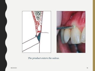 08/20/2024 86
The product enters the sulcus.
 