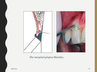08/20/2024 87
The marginal gingiva blanches.
 