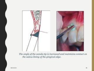 08/20/2024 88
The angle of the canula tip is increased and maintains contact on
the sulcus lining of the gingival edge.
 