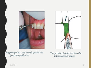 08/20/2024 89
The product is injected into the
interproximal space.
Support points: the thumb guides the
tip of the applicator.
 